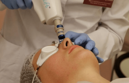 Nichtablebbare Laserverjüngung