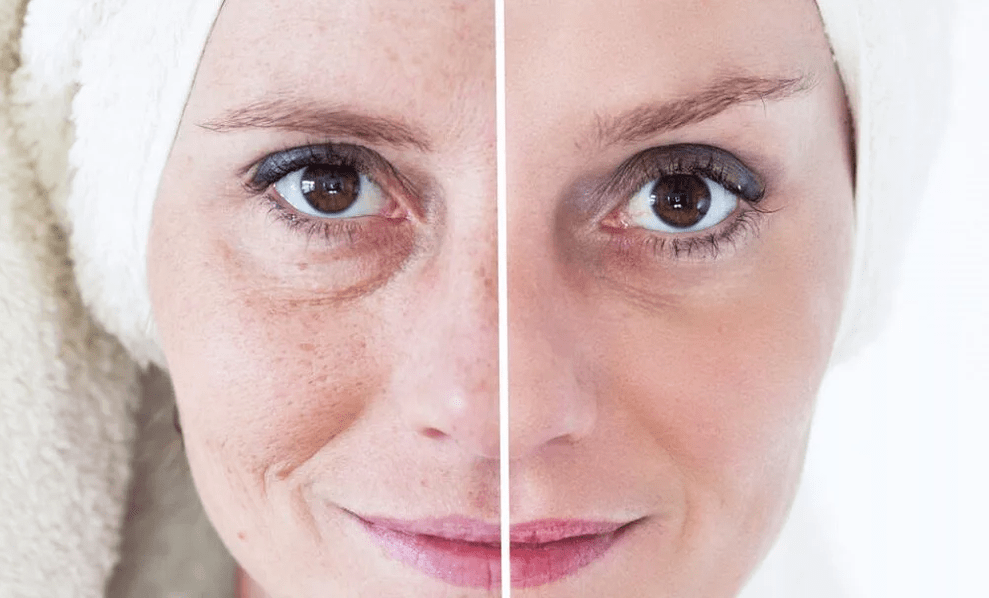 Laser-Gesichtsverjüngung